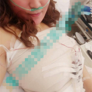 分享我自體脂肪隆胸手術(shù)前后對比照片，果不錯哦~