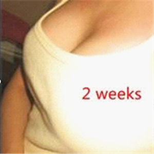 分享我自體脂肪隆胸手術(shù)前后對比照片，果不錯哦~