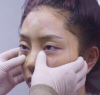 自體脂肪隆鼻、墊下巴、豐蘋(píng)果肌前后對(duì)比圖和恢復(fù)過(guò)程分享