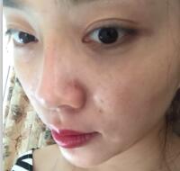 自體脂肪隆鼻、墊下巴、豐蘋(píng)果肌前后對(duì)比圖和恢復(fù)過(guò)程分享