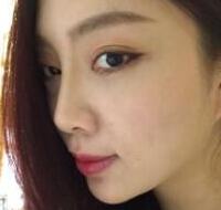 自體脂肪隆鼻、墊下巴、豐蘋(píng)果肌前后對(duì)比圖和恢復(fù)過(guò)程分享