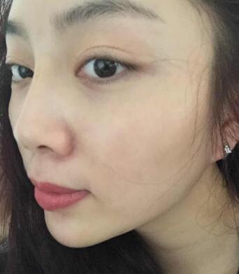 自體脂肪填充面部術后圖片分享