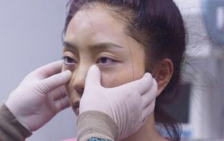 自體脂肪面部填充術前檢查