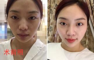 自體脂肪面部填充前術后對比照