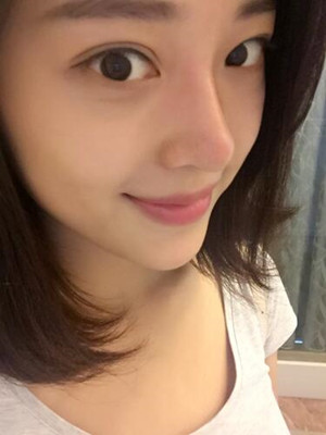 翟爽給我打玻尿酸隆鼻做出了假體的感覺(jué)