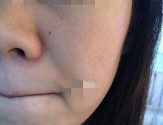 北京歐華像素激光去痘印痘坑 果很棒哦~