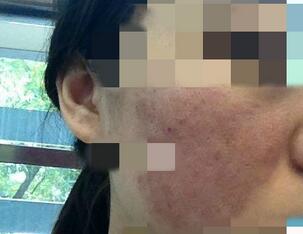 北京歐華像素激光去痘印痘坑 果很棒哦~