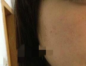 北京歐華像素激光去痘印痘坑 果很棒哦~