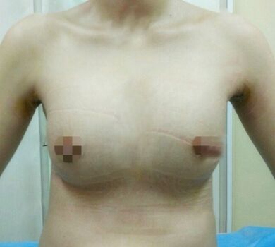 完全平胸的我做了假體隆胸之后終于有胸了