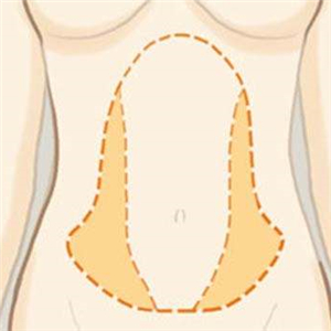 京韓做腰腹吸脂四個(gè)月的恢復(fù)照片，喬愛軍醫(yī)生的技術(shù)很好哦~