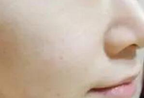 白瓷娃娃緩解一次后，皮膚能直觀看出來水潤白皙緊致了一些