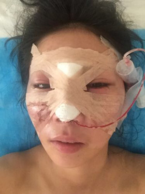 隆鼻手術前后過程對比圖，真實案例分享