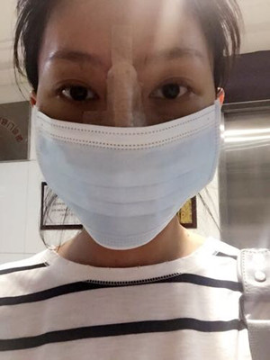 隆鼻手術前后過程對比圖，真實案例分享