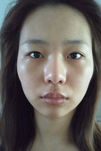 磨骨+下巴矯正手術前后過程(膽小勿入!)真實案例分享