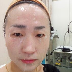 激光祛斑20天后的圖片 北京歐華王芳