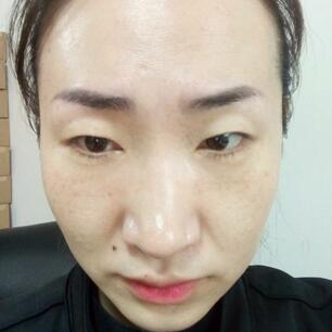 激光祛斑20天后的圖片 北京歐華王芳