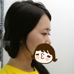 去年做的自體脂肪隆鼻手術，曬一下前后對比果圖片~