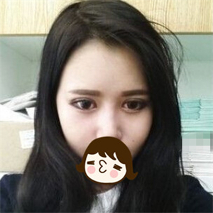 去年做的自體脂肪隆鼻手術，曬一下前后對比果圖片~