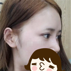 去年做的自體脂肪隆鼻手術，曬一下前后對比果圖片~