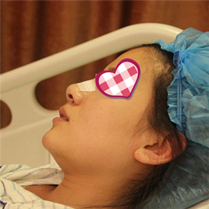 分享我自體軟骨隆鼻前后對比果圖片和恢復過程，在愛斯克做的哦~