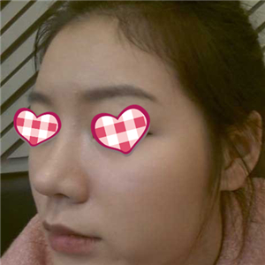 分享我自體軟骨隆鼻前后對比果圖片和恢復過程，在愛斯克做的哦~