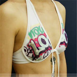 自體脂肪移植隆胸三個(gè)月了，分享恢復(fù)前后對(duì)比果照片~