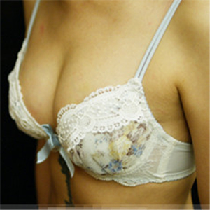 自體脂肪移植隆胸三個(gè)月了，分享恢復(fù)前后對(duì)比果照片~