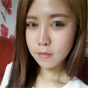 去年做了玻尿酸填充去法令紋，有前后對(duì)比果圖片哦~