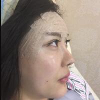 自體脂肪面部填充——豐太陽穴豐額頭恢復(fù)過程真實(shí)案例分享