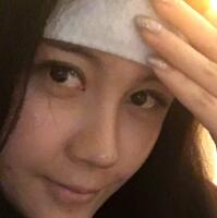 自體脂肪面部填充——豐太陽穴豐額頭恢復(fù)過程真實(shí)案例分享