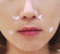 注射玻尿酸除皺價(jià)格3600元，術(shù)后果分享