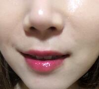 注射玻尿酸除皺價(jià)格3600元，術(shù)后果分享