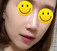 注射玻尿酸除皺價(jià)格3600元，術(shù)后果分享