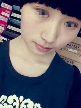 做了切開雙眼皮手術，現(xiàn)在恢復的還不錯哦