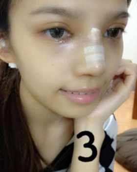 記錄了隆鼻三個月前后的恢復過程，希望可以幫到有需要的朋友