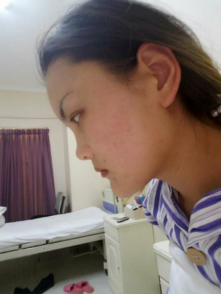 和大家分享一下我做自體脂肪面部填充的經(jīng)歷 還有果圖哦