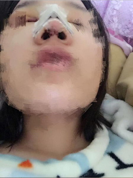 隆鼻整形手術(shù)讓我的塌鼻子重獲新生