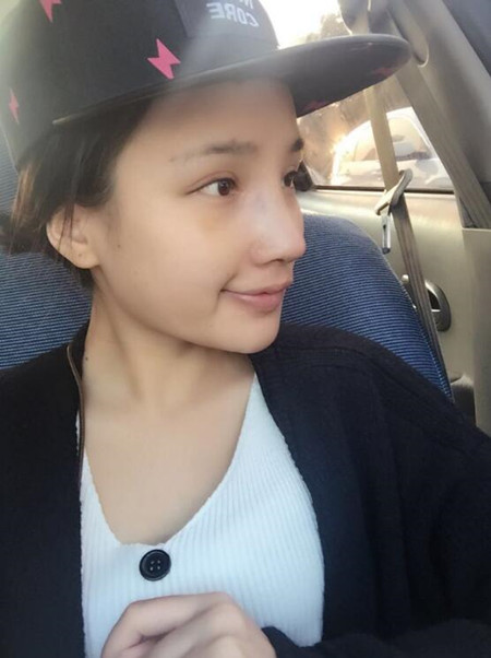 隆鼻整形手術(shù)讓我的塌鼻子重獲新生