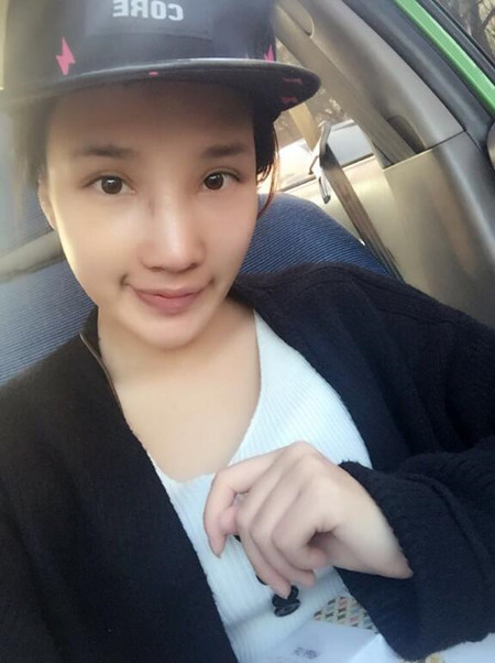 隆鼻整形手術(shù)讓我的塌鼻子重獲新生