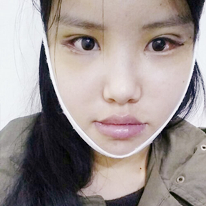 做下頜角整形手術(shù)半年了，給你們看看恢復(fù)過程照片吧~