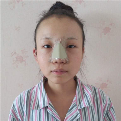 磨下頜角手術(shù)+隆鼻前后對(duì)比果圖片分享，高占巍做的哦~