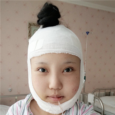 磨下頜角手術(shù)+隆鼻前后對(duì)比果圖片分享，高占巍做的哦~