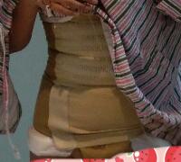 抽脂減肥瘦腰腹親身經(jīng)歷和前后對(duì)比圖分享