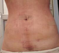 抽脂減肥瘦腰腹親身經(jīng)歷和前后對(duì)比圖分享