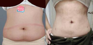 抽脂減肥前后果圖對比