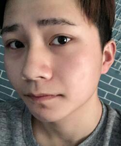 注射注射瘦臉B****恢復(fù)圖