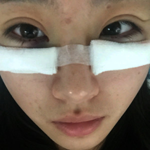 祛眼袋半年了，曬曬我的恢復(fù)前后對比果圖片哦