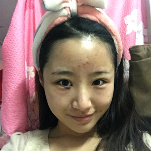 祛眼袋半年了，曬曬我的恢復(fù)前后對比果圖片哦