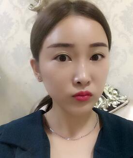 愛(ài)悅麗格玻尿酸豐蘋果肌、豐下巴、隆鼻