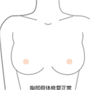 老媽隆胸失敗假體取出，還是自然點好~